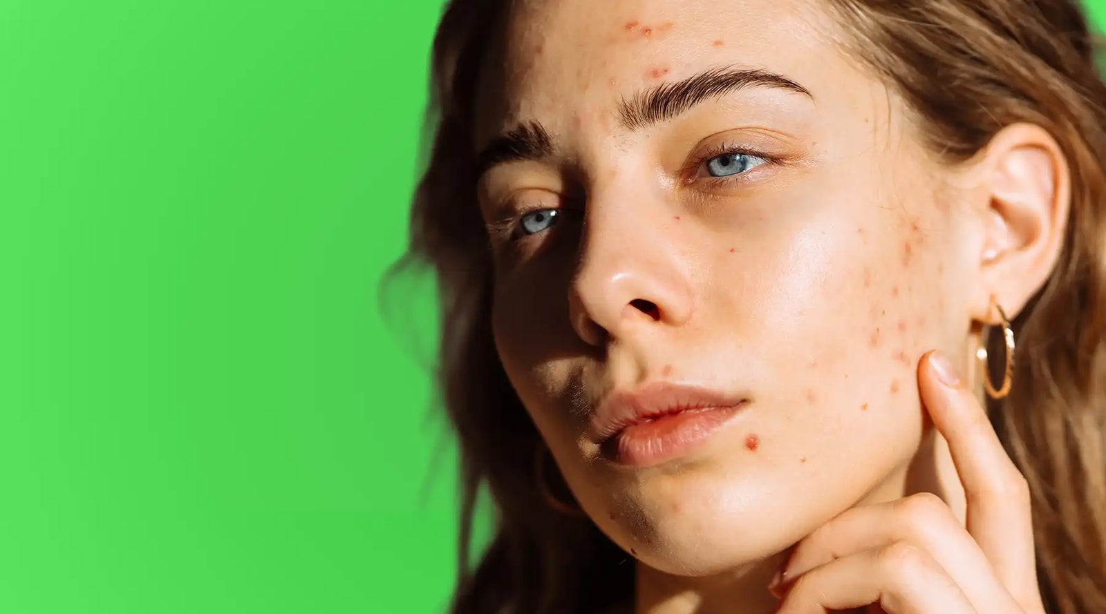 Treat Post-Holiday Breakouts (Without Drying Out Your Skin)