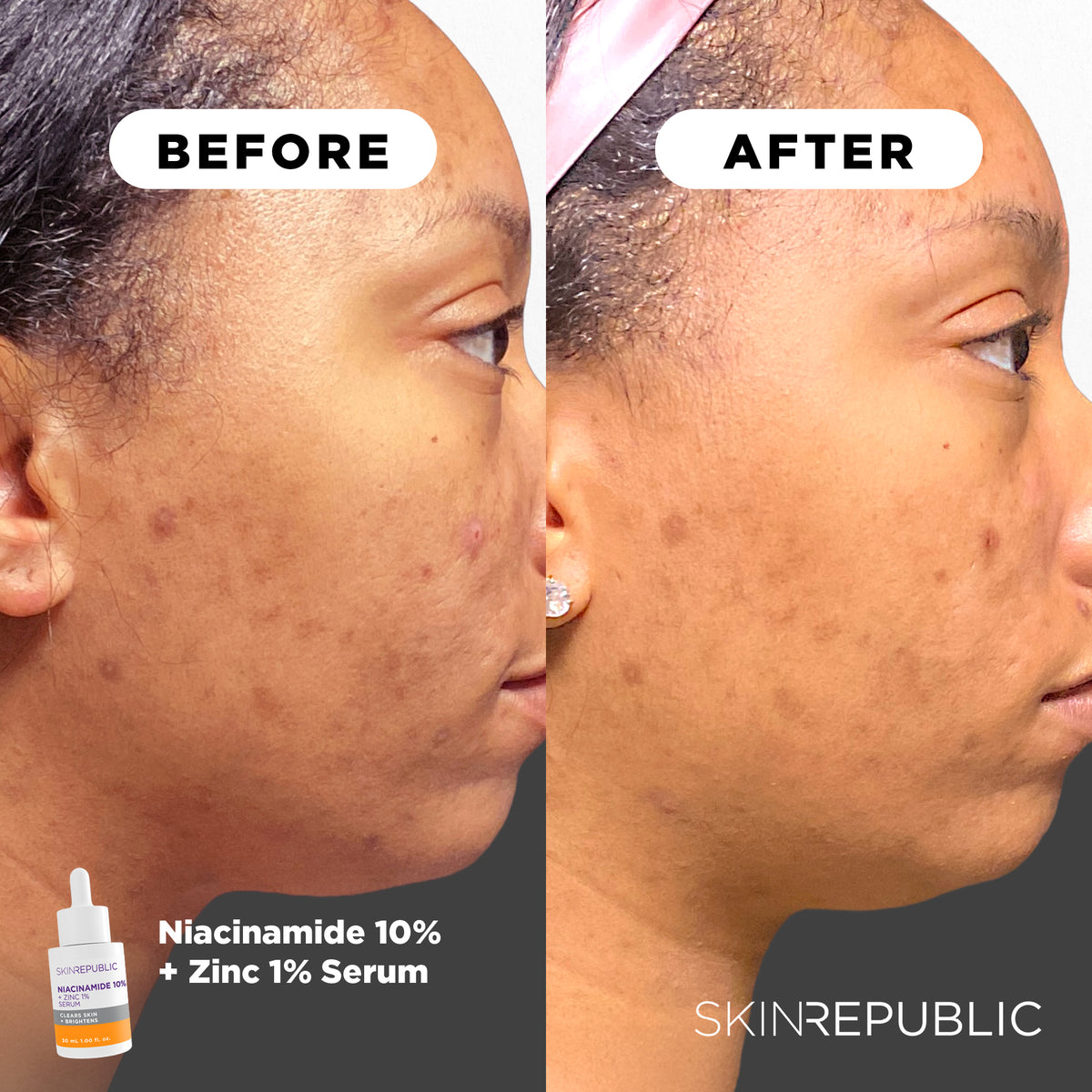 Niacinamide 10% + Zinc 1% Serum